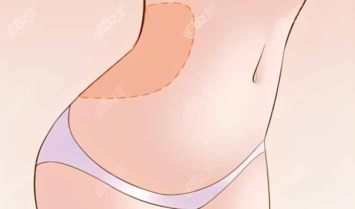 谢宏彬腹壁成形手术疗效怎么样