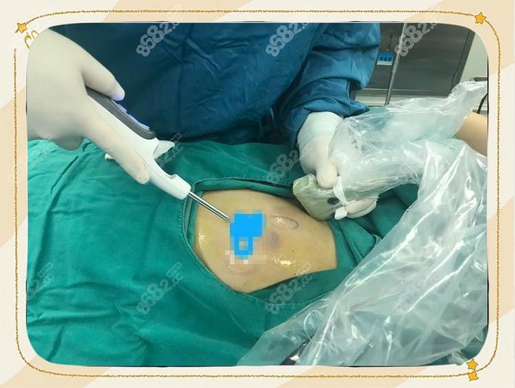 乳腺清奥手术花了20万?真实修复日记:6个月修复全过程记录