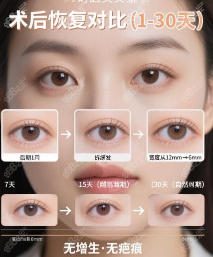 上海郑小红双眼皮改成内双的实例：术后不同阶段的变化