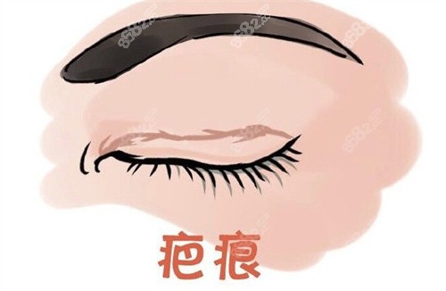 双眼皮术后疤痕