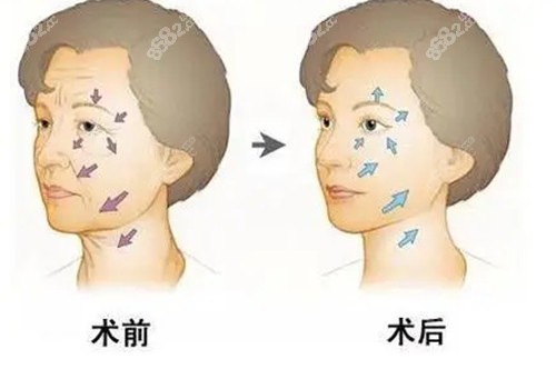 袁强博士拉皮对比.jpg