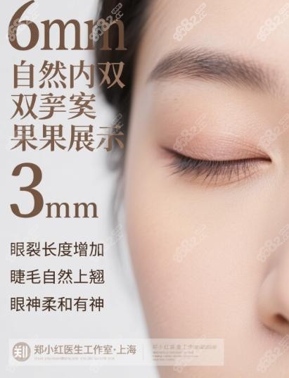 上海郑小红双眼皮改成内双的实例：顾客的真实反馈