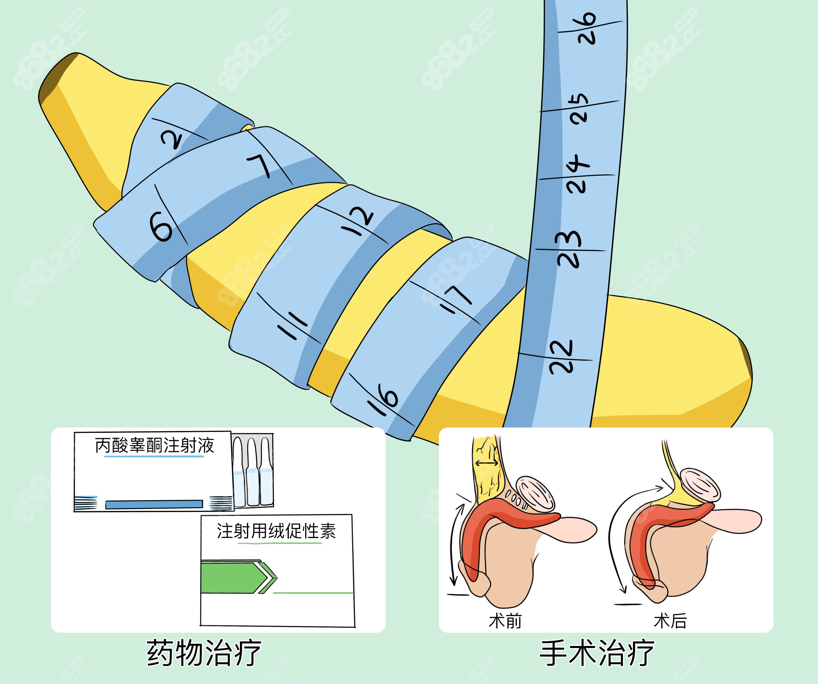 李世荣医生有失败过吗?5位阴茎延长增粗术患者3年跟踪反馈