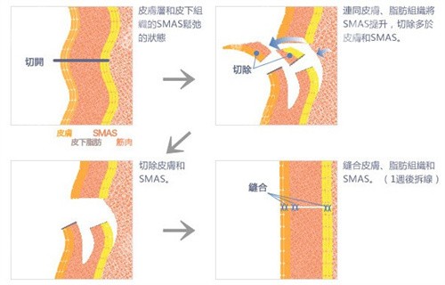 面部筋膜悬吊手术示意图