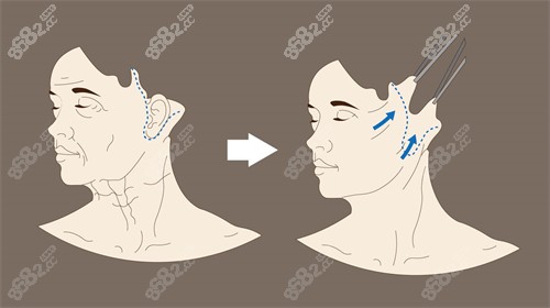 袁强博士拉皮提拉角度示意图.jpg