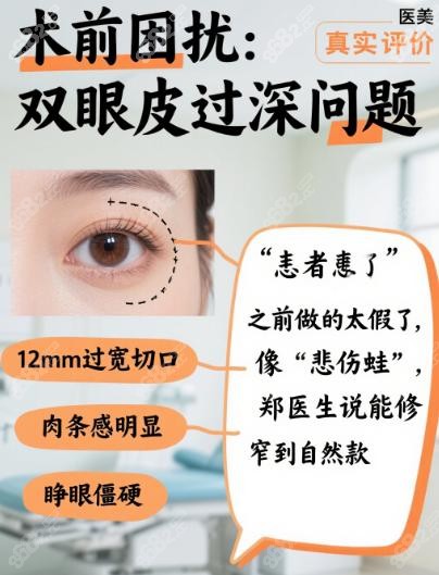 上海郑小红修复眼睛真实评价来喽~双眼皮深改浅修成6mm自然