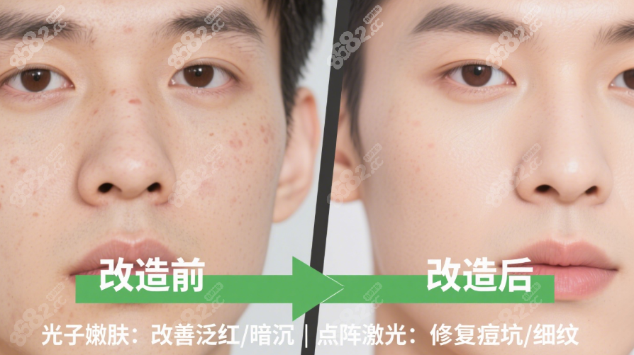 光子嫩肤前后对比