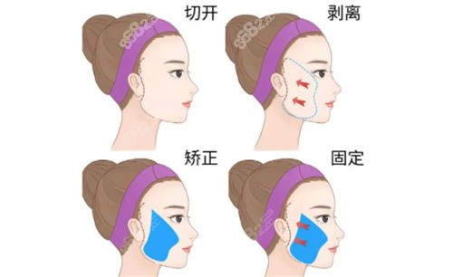 袁强博士拉皮过程示意图.jpg