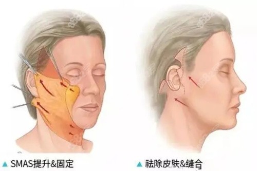 上海筋膜提升手术对比图