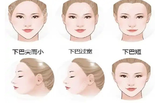 倪锋拉皮术