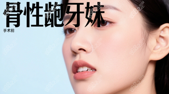 肖林正颌口碑真实反馈:骨性龅牙妹术后侧颜逆袭,下巴长出8mm