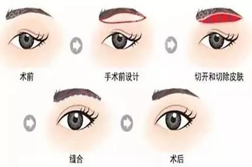 重庆胡金香切眉示意图 重庆胡金香切眉示意图