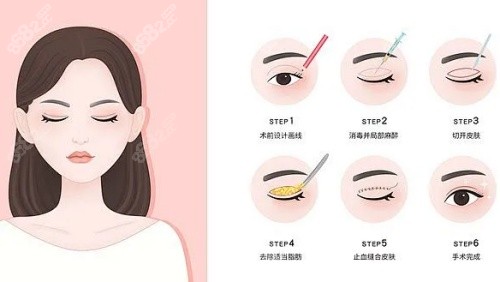 重庆胡金香医生简介:擅长眼眉，做双眼皮及修复手术好