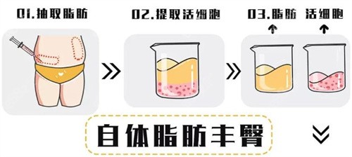 北京任学会脂肪填充咋样？剖析资质/技术优势及整友评价