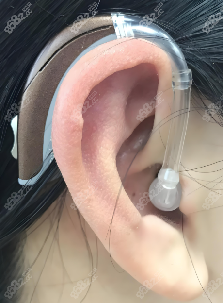 耳畸形矫正