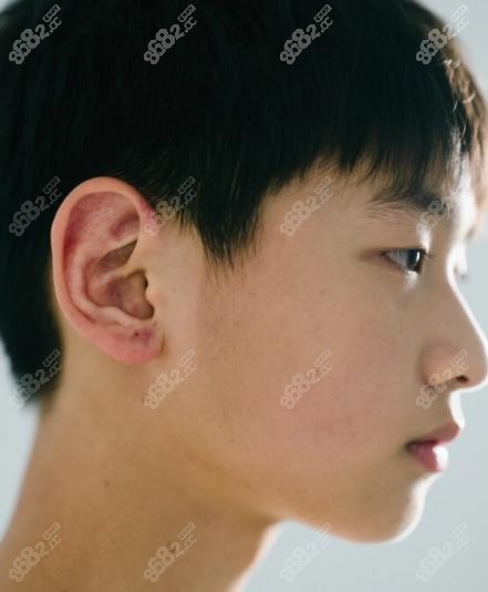 安波博士耳再造生物支架爆火!00后小伙用它逆袭精灵耳男神