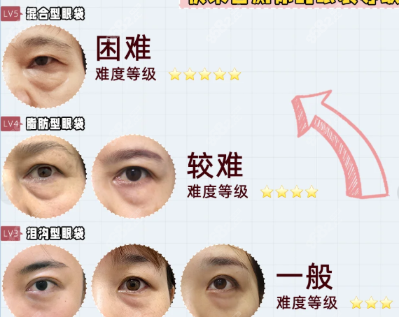 卢尚兵和齐丙迪去眼袋手术价格