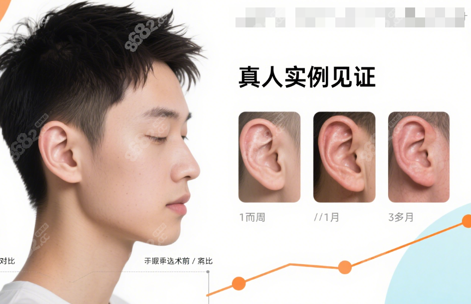张正文耳再造实例成效好不贵