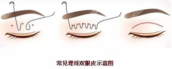 北京双眼皮修复医生排名前十名
