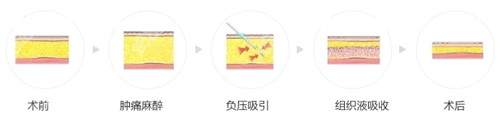 吸脂过程图解