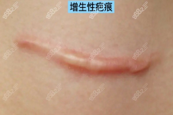 成都疤研疤痕醫(yī)院祛疤好評情況之治療技術(shù)優(yōu)勢