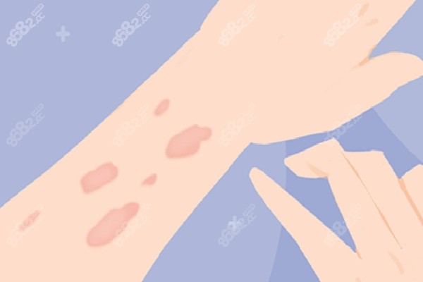 成都疤研疤痕醫(yī)院祛疤痕價格是否貴之價格總體評估