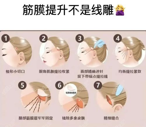 赵鹏医生苹果肌+法令纹提升3万左右