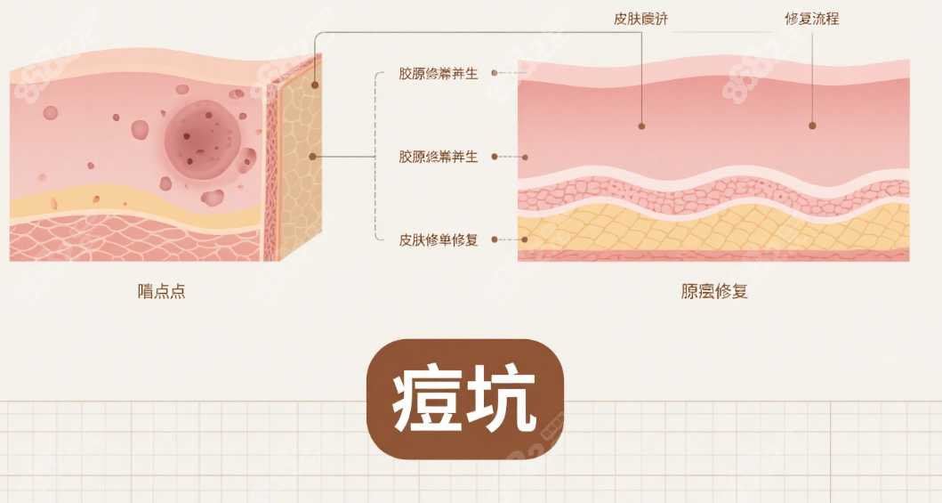 痘坑修复做医美是不是智商税？
