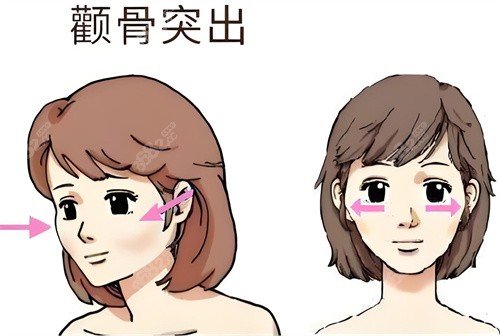 颧骨突出动画图