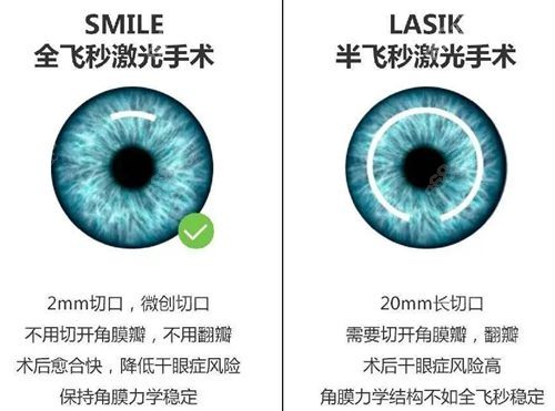 河北省二院眼科全飞秒真实手术实例分享