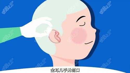 张正文医生做过的耳再造几千例