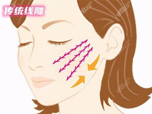 苹果肌线雕提升术动画演示图