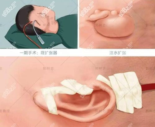 郭树忠耳再造一期