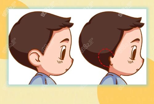 师俊莉做小耳再造成效显著