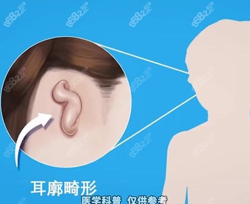 师俊莉做小耳再造成效好,师承郭树忠技术扎实费用不高5万起