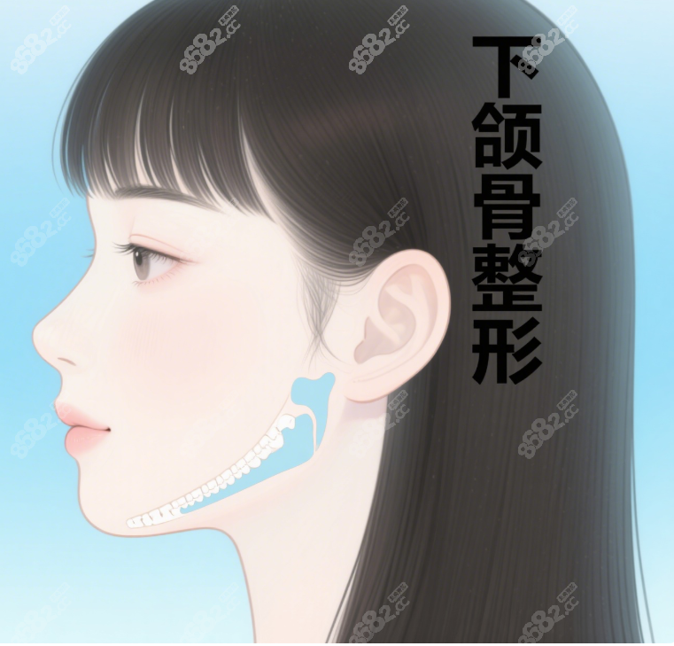 下颌骨整形