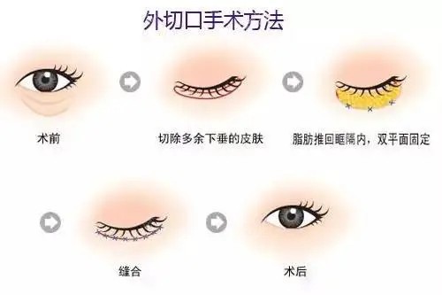 眼袋整形卡通示意圖 眼袋整形卡通示意圖