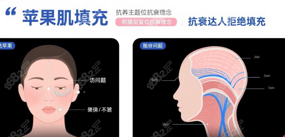 为什么抗衰达人拒绝苹果肌填充 为什么抗衰达人拒绝苹果肌填充