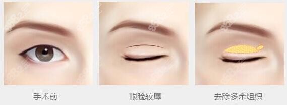 眼部整形金刀獎(jiǎng)國內(nèi)有幾人？18人名單公布含杜園園劉志剛等