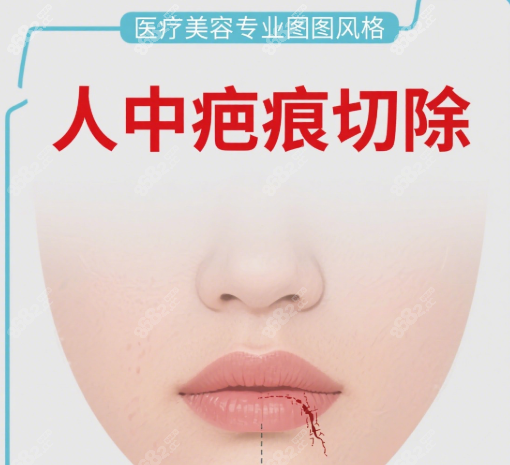 人中疤痕切除
