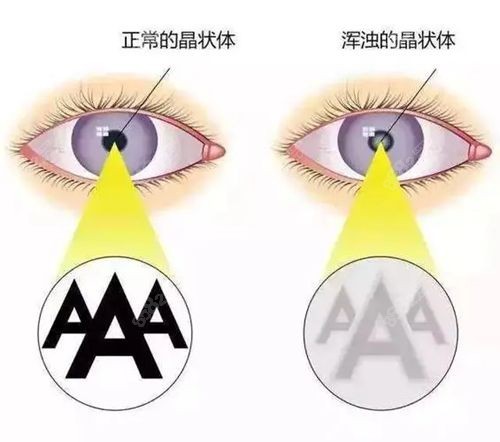 2025广东省白内障手术免费政策怎么申请
