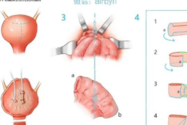 泰國變性手術(shù)術(shù)后護(hù)理要注意什么