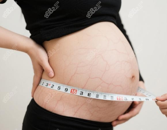 崔鑫腹壁整形三個月真實反饋：價格與性價比