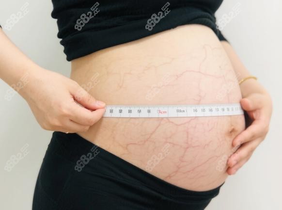 崔鑫腹壁整形三個月真實反饋：術(shù)后護理全攻略