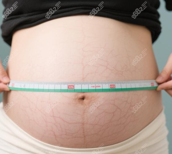 崔鑫腹壁整形三个月真实反馈~腰围缩减​​8-15cm,妊娠纹淡化