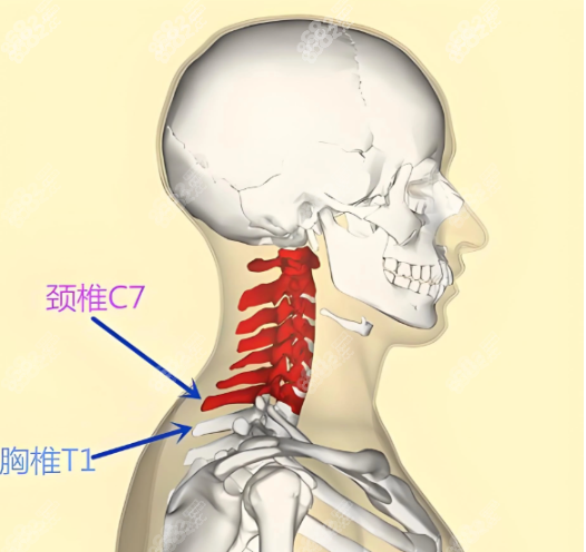 李方伟富贵包微创术在哪家医院