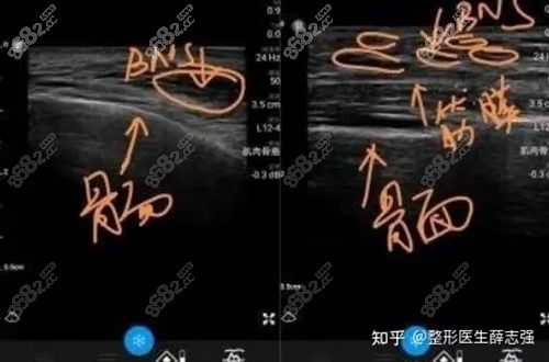 王阔远面部减容实力