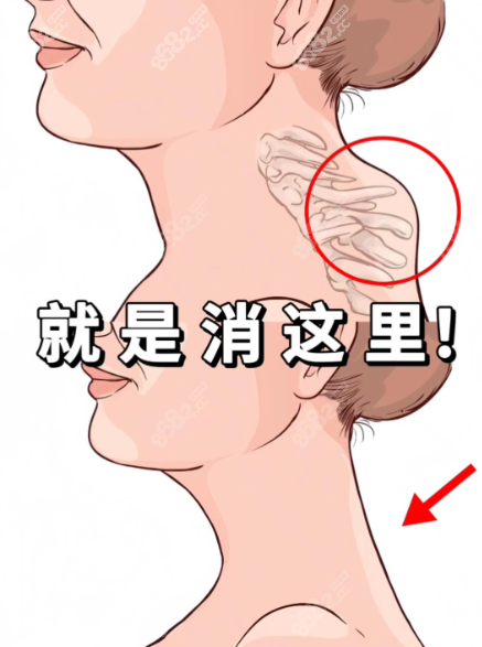 低头族必看!李方伟富贵包微创术在哪里?1.2mm针孔当天甩包袱