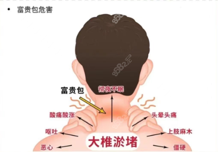李方伟富贵包微创术怎么样