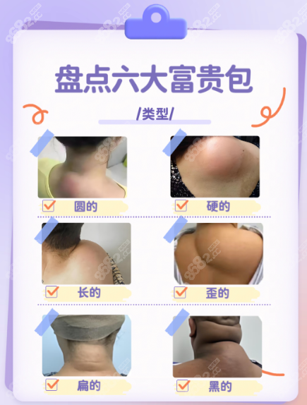 李方伟富贵包微创术预约挂号